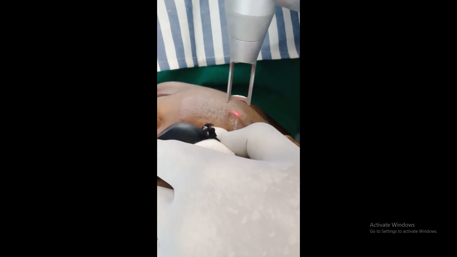 MNRF Treatment